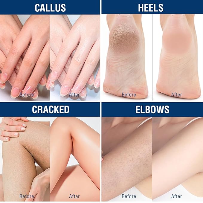 OUKEYA Urea Cream 40 Percent, Foot & Hand Cream for Dry Cracked, Urea Lotion for Feet Maximum Strength(12.35Oz)