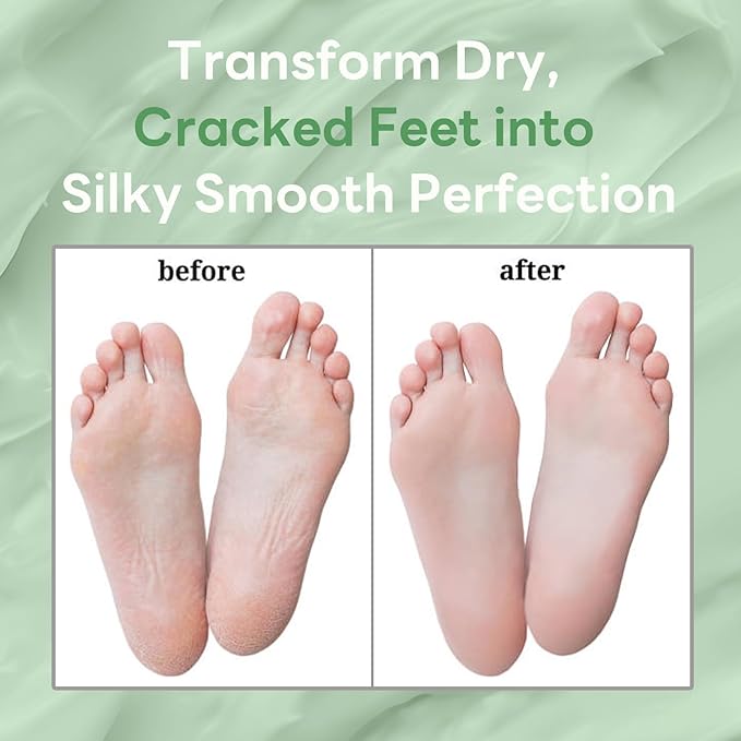 60% Urea Cream Stick with Tea Tree Oil & Aloe Vera, Maximum Strength Foot Cream for Dry Cracked Heels, Feet Callus Remover, Dead Skin Exfoliator, Moisturizing Lotion for Hands, Knees, Elbows - 1.41oz