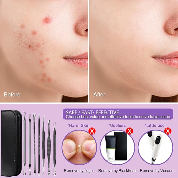 Teenitor 7 in 1 Blackhead Remover Tools, Surgical Grade Pimple Popper Tool Kit, Blackhead Extractor, Pimple Extractor, Black Head Remover for Face Nose