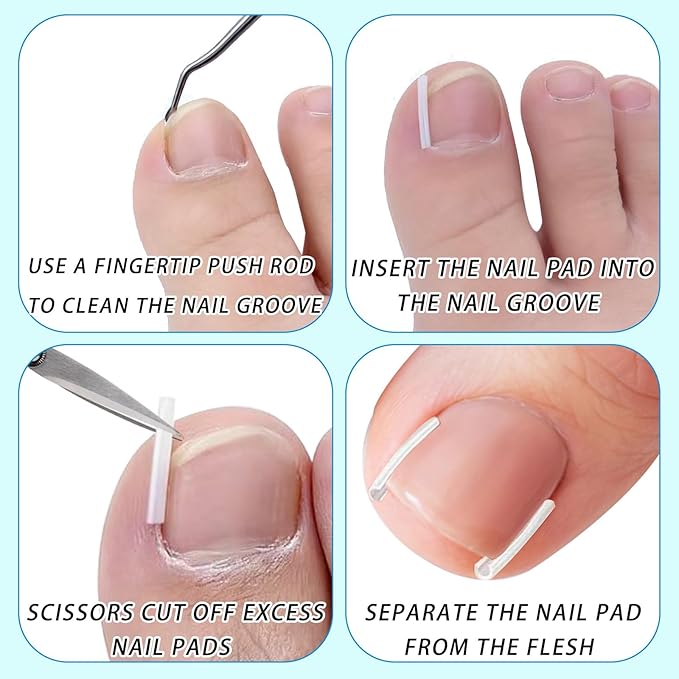 Ingrown Toenail Treatment,Professional Ingrown Toenail Removal Kit,Home Care Nail Clipper Set Suitable for Foot Care Repair