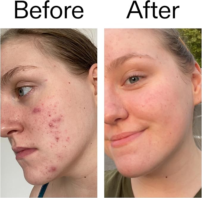 The INKEY List 10% Glycolic Acid Toner 3.4 Fl Oz, Includes Witch Hazel, Pore Minimising Toner, Brightens Skin, Vegan Friendly, Suitable for Normal/Oily Skin