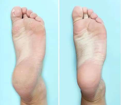 Ever Ready Corn & Callus Trimmer Refills x 4 - - Instant Relief from Corns | Removes Dry, Hard & Cracked Skin | Home Pedicure Treatment for Footcare