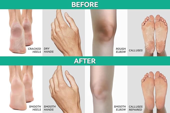 CLEAR 40, 40% Urea Gel, 4 oz w/Tea Tree & Coconut Oil, Aloe Vera Extract, Works on Calluses & Corns, Moisturizes & Softens Cracked Heels, Feet, Elbows, Hands, Nails, Superior Hydration to Urea Creams