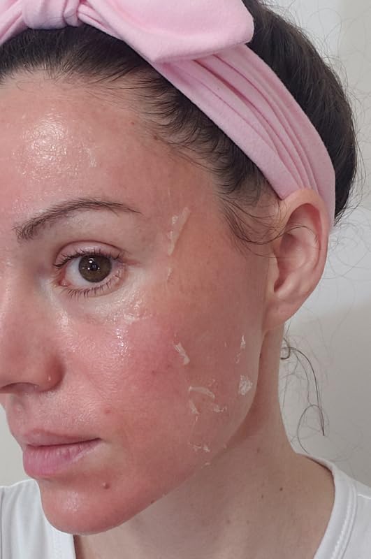 TCATherapyCare Solution Acid Peel 70% Gel Peel, Chemical Peels for Face Breakout Scars, Chemical Exfoliant for Face, Strength Level 2, 1.0 fl oz. e, 30 mL – KIAEVA COSMETICS