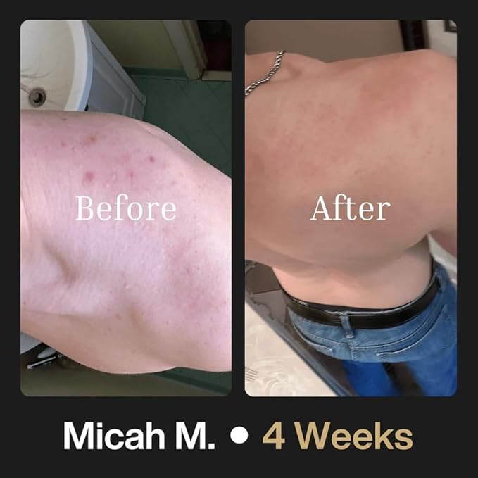 Shield Maximum Strength Body Wash for Back, Chest & Shoulders - Men's 10% Benzoyl Peroxide Body Wash, Clears Breakouts & Acne Scars – Unscented with Niacinamide, Glycolic Acid & Ceramides, 8.5 oz