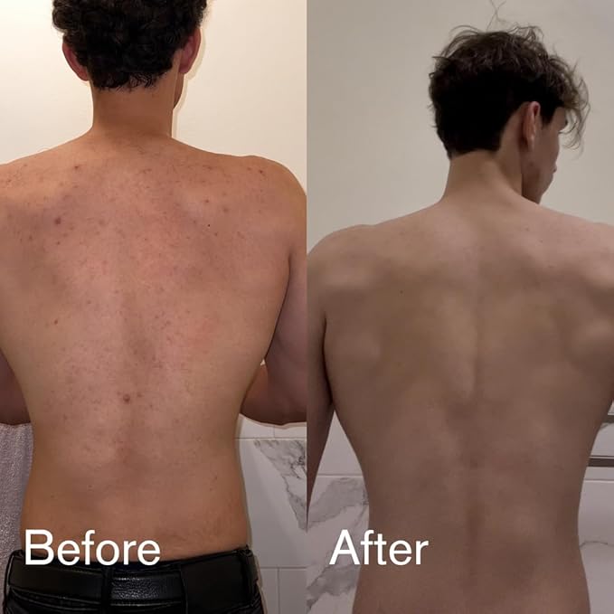 Shield Body Acne Wash for Men and Boys – Unscented Back & Chest Cleanser, Clears Acne & Breakouts, 8.5 oz, Pack of 2