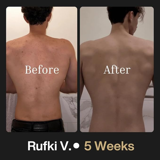 Shield Maximum Strength Body Wash for Back, Chest & Shoulders - Men's 10% Benzoyl Peroxide Body Wash, Clears Breakouts & Acne Scars – Unscented with Niacinamide, Glycolic Acid & Ceramides, 8.5 oz