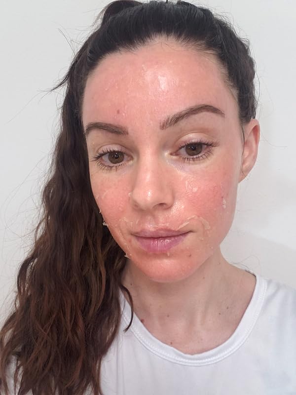 TCATherapyCare Solution Acid Peel 70% Gel Peel, Chemical Peels for Face Breakout Scars, Chemical Exfoliant for Face, Strength Level 2, 1.0 fl oz. e, 30 mL – KIAEVA COSMETICS