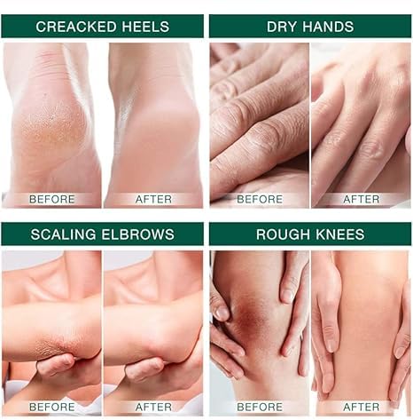 Urea Cream for Foot 42% +2% Salicylic Acid, Foot & Hand Cream for Feet Maximum Strength Moisturizes Nourishes Softens Dry, Rough, Exfoliates Dead Skin Callus Remover For Feet 3.53oz