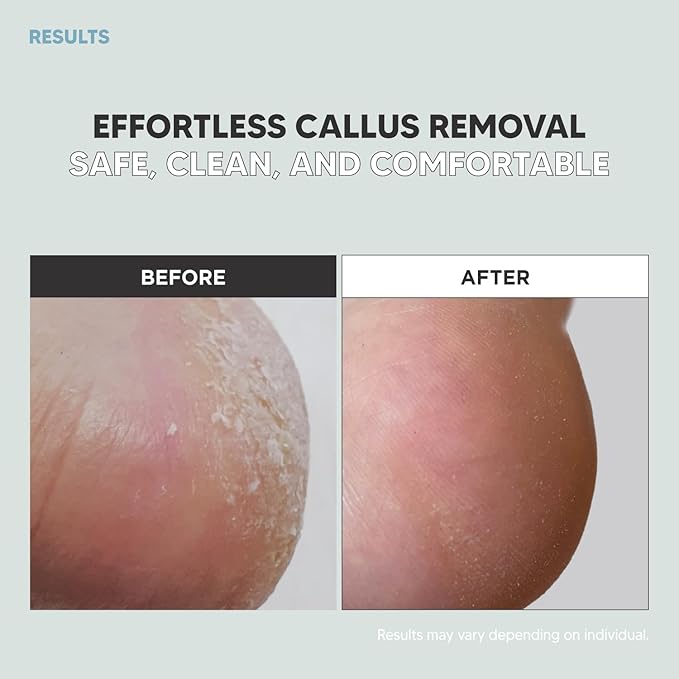 Callus Razor(3pack), Pedicure Tool, Effective for Cracked Heel, Ergonomic Design for Grip, Safety Stainless Steel Callus Shaver, Blade for Foot Care, Hard, Rough,Thick Callused Skin Remover