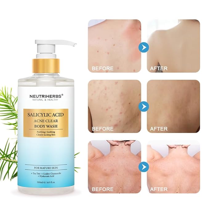 Neutriherbs Acne Body Wash, Anti Acne/Prone Skin Shower Gel For Women And Men, Daily Shower Soap With Salicylic Acid - Grapefruit Scent 16.9 Fl.Oz