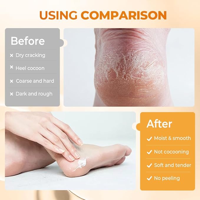 60% Urea Hydrating and Anti-Cracking Foot Cream, Moisturising and Relieves Cracking and Dryness Foot Cream for Cracked Heels,Hands,Knees,Exfoliating Moisturizer (Yellow*2, one size)