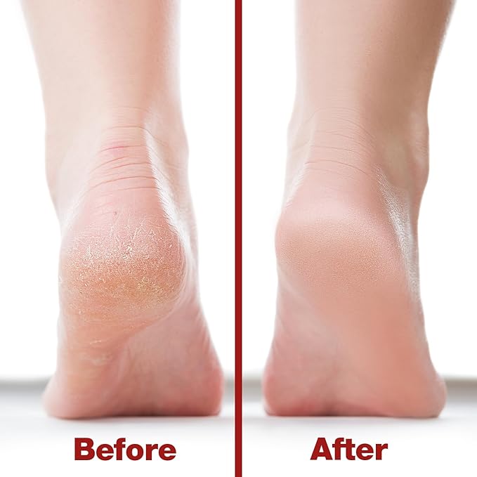 Probelle Double Sided Multidirectional Nickel Foot File Callus Remover - Immediately Reduces calluses and Corns to Powder for Instant Results, Safe Tool (Red)
