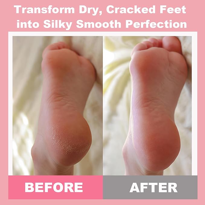 60% Urea Cream plus 2% Salicylic Acid - Maximum Strength Foot Cream for Dry Cracked Heels, Callus Remover, Dead Skin Exfoliator, Peach Scent Moisturizing Lotion for Hands, Knees, Elbows - 1.41oz