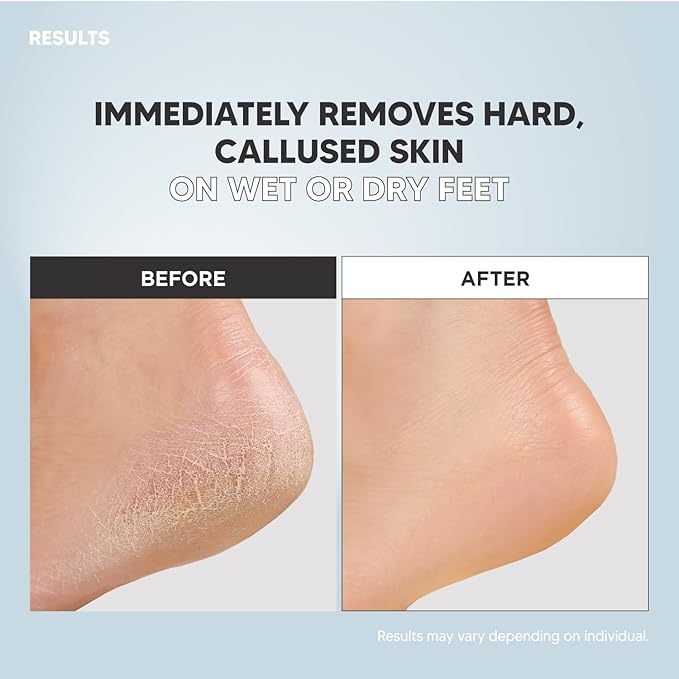 S-Line Emery Foot File & Foot Spray Set, Colossal Double-Sided Pedicure Tool, Effective for Cracked Heel, Ergonomic Design for Easy Grip, Dead Skin Remover, Callus Rasp, Scrubber