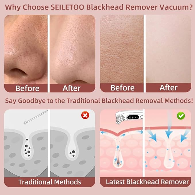 5-Speed Blackhead Remover Vacuum, Wireless Charging Nose Pore Extractor with 4 Removable Heads,Facial Vacuum Pore Cleaner,30-Second Keratin Softening, Hypoallergenic Deep Cleansing
