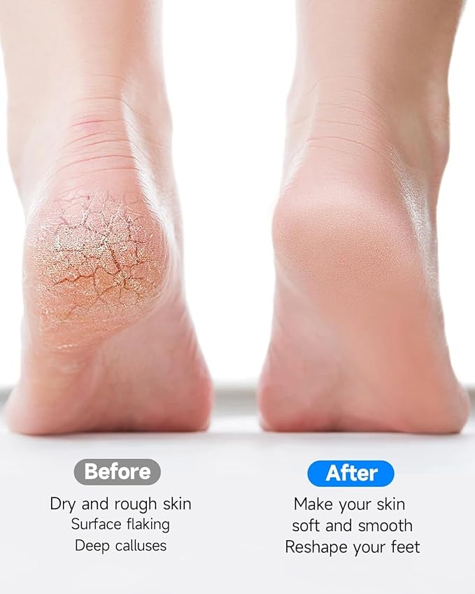 Electric Foot Callus Remover for Women Men, Electric Foot File with Stainless Steel Heads, Rechargeable Callus Remover for Feet, Portable Feet Grinder for Cracked Dry Heels, Dead Skin Calluses