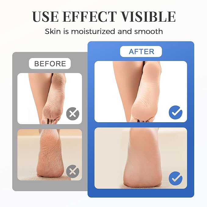 Urea Foot Care Stick 60% Urea with 2% Salicylic Acid, 2025 Upgraded Foot Cream for Dry Cracked Feet, Knees, Elbows, Hands, Foot Lotion Heel Stick for Men Women (Coconut and aloe vera)