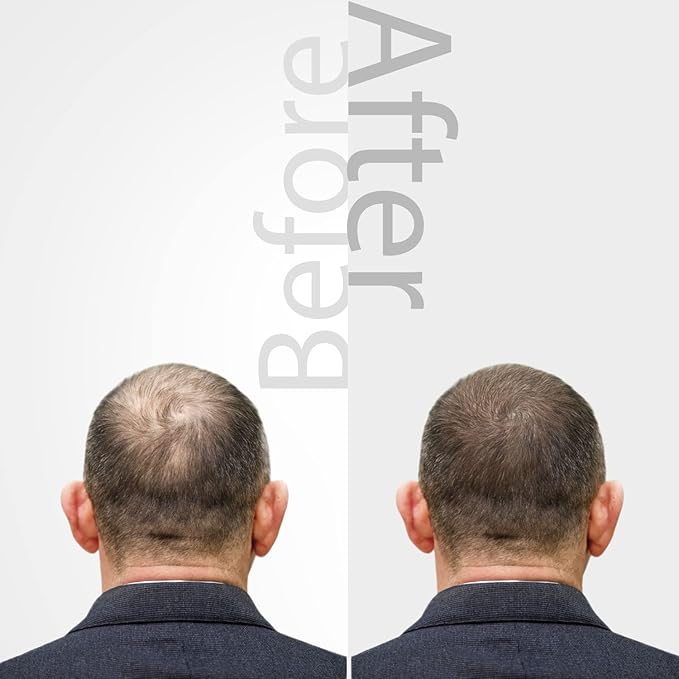 The Mossi London Ozonized Oil Serum Complex Intensive Scalp Repair Oil for Post Hair Transplant | Ozonated Olive Oil 50% 30ML