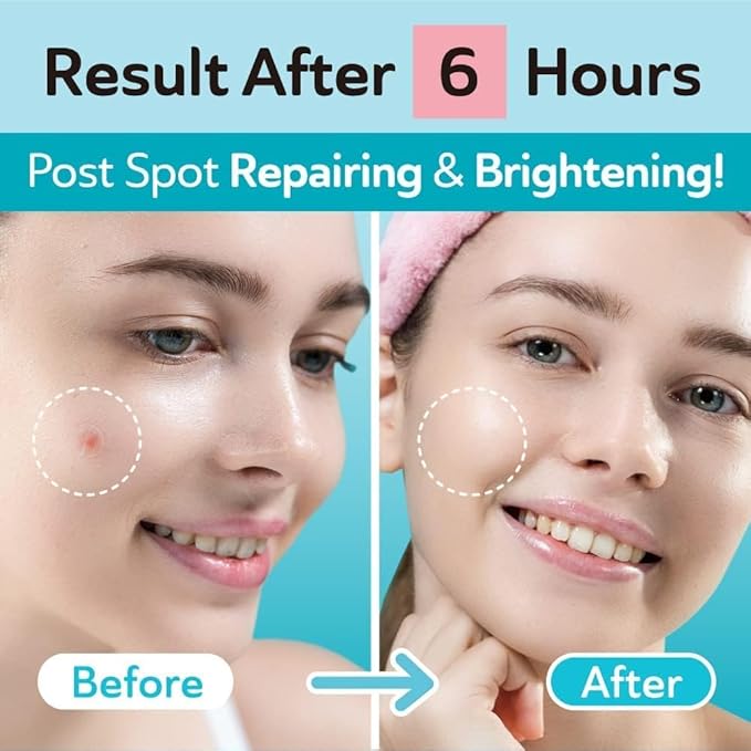 Ultra Invisible Dark Spot Patches & Salicylic Acid Acne Patches Bundle – Effective Acne Spot Treatment for Day & Night Use, Blemish, Post-Acne Marks, Hydrocolloid, 264 Total Patches – Bundle