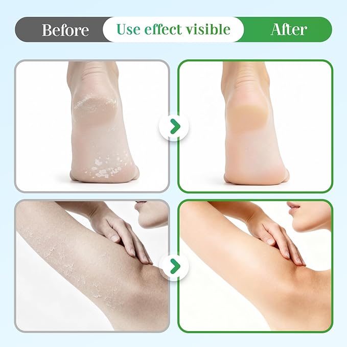 60% Urea Hydrating and Anti-Cracking Foot Cream, 2026 Upgraded Hydrating Foot Care Stick, Moisturizing Balm for Dry Cracked Heels, Hands, Knees Elbows, Foot Repair Stick (3)