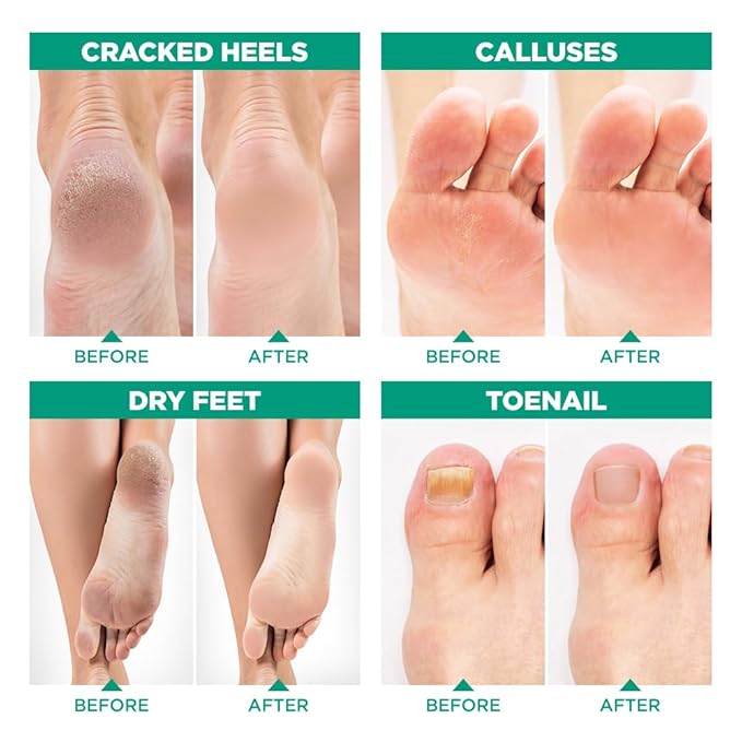 Tea Tree Oil Foot Soak and 40% Urea Cream - for Dry Cracked Feet with Maximum Strength