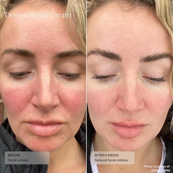 Senté Dermal Repair Facial Cream | Nourishing for Rosacea & Sensitive Skin | Hydrate & Soothe | with Patented HSA, Vitamin E & Green Tea Extract - 1.7 Fl Oz