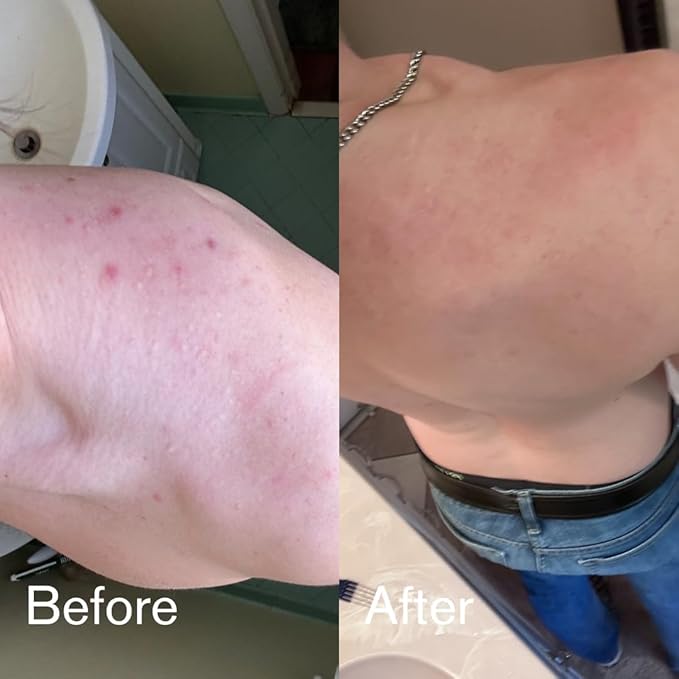 Shield Body Acne Wash for Men and Boys – Unscented Back & Chest Cleanser, Clears Acne & Breakouts, 8.5 oz, Pack of 2