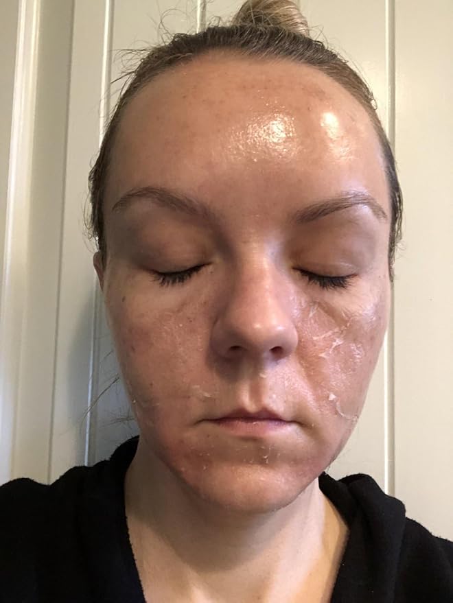 TCATherapyCare Solution Acid Peel 25% Gel Peel, for Face Breakout Scars, Chemical Exfoliant for Face, Strength Level 2, 1.0 fl oz. e, 30 mL – BUY1GET1FREE