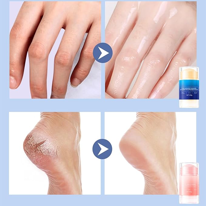 Feet Cracking Prevention Stick,Anti-Cracking Foot & Hand Cream Moisturizer for Dry Cracked Heel Feet, Knee, Elbow, Foot Balm Stick for Callus Remover & Dead Skin Softener (Pink+Blue)