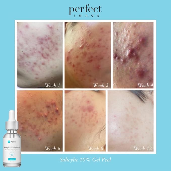 Salicylic 10% Gel Peel, Breakout and Pore Minimizer and Cleanser, 15-30 Full Facial Chemical Peels, 1 fl oz. e, 30 mL – Perfect Image