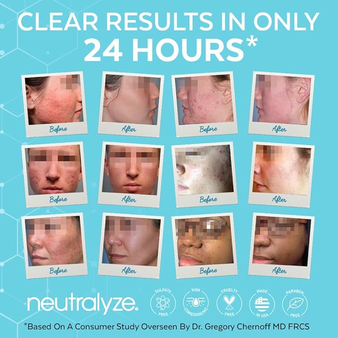 Neutralyze Exfoliating Acne Toner Pads - Dual Textured, Maximum Strength Acne Wipes for Face & Body with 2% Salicylic Acid & 2% Mandelic Acid for Teens & Adults (100 Wipes)