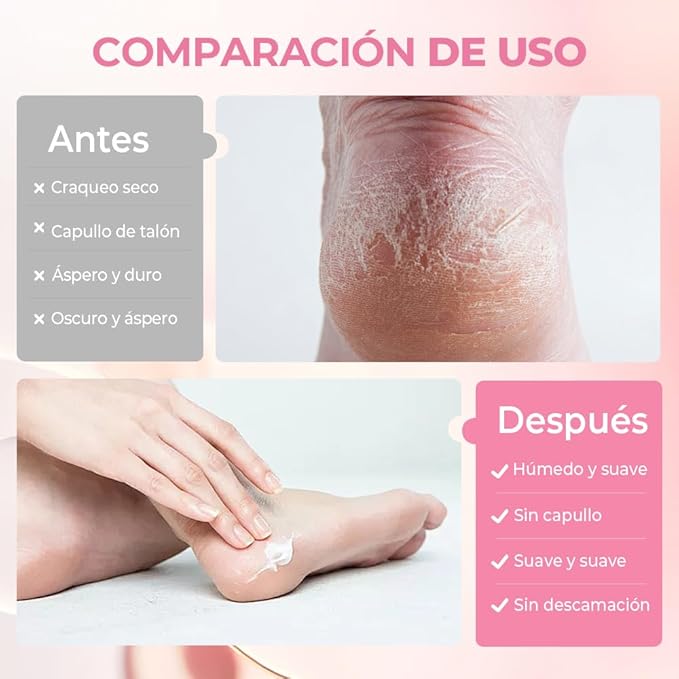 60% Urea Hydrating and Anti-Cracking Foot Cream, Moisturising and Relieves Cracking and Dryness Foot Cream for Cracked Heels,Hands,Knees,Exfoliating Moisturizer (Pink, one size)