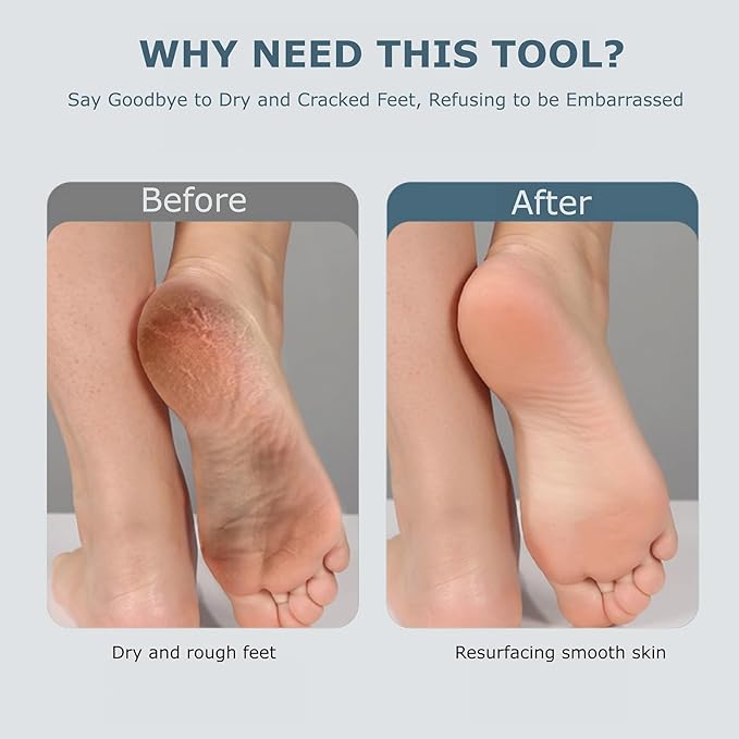Upgraded Electric Foot Callues Remover, Portable Electric Foot Files with 3 Heads, Rechargeable Feet File for Foot Care, Waterproof Deadskin Remover, Pedicure Tool for Dry and Crack Feet