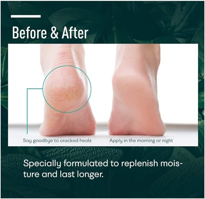Urea cream 40 perent for feet: Maximum Strength Urea lotion for cracked Heels and Rough Thick Skin for foot- 42% Crema 5.29 oz.