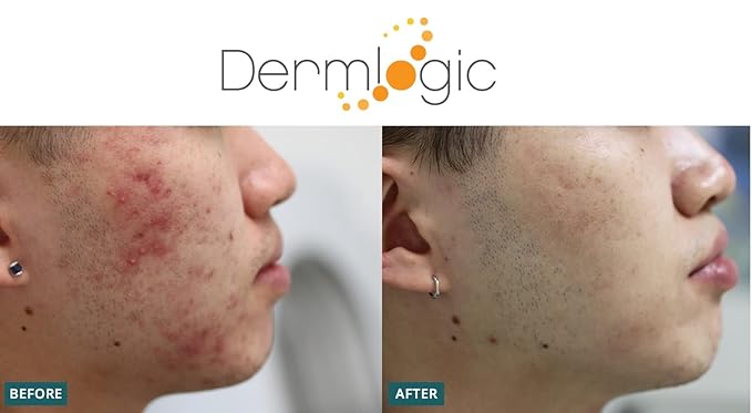 Acne Treatment Pads- Contains Salicylic, Glycolic, & Lactic Acid for Face & Body. Clears Away Clogged Pores, Oily Skin & Cystic Breakouts. Removes Dark Spots, Blackhead & Whitehead Pimples