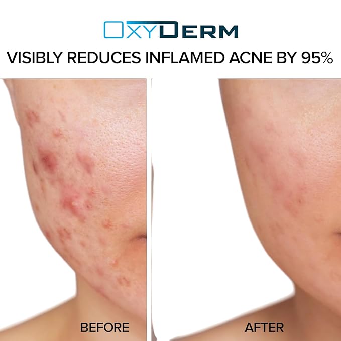 Acne Treatment Pads- Eliminates Pimple, Whitehead, blackhead, & Cystic Breakouts. Clear Clogged Pores, Oily Skin, Blemish, Dark Spots & Improve Skin Texture. 60 count