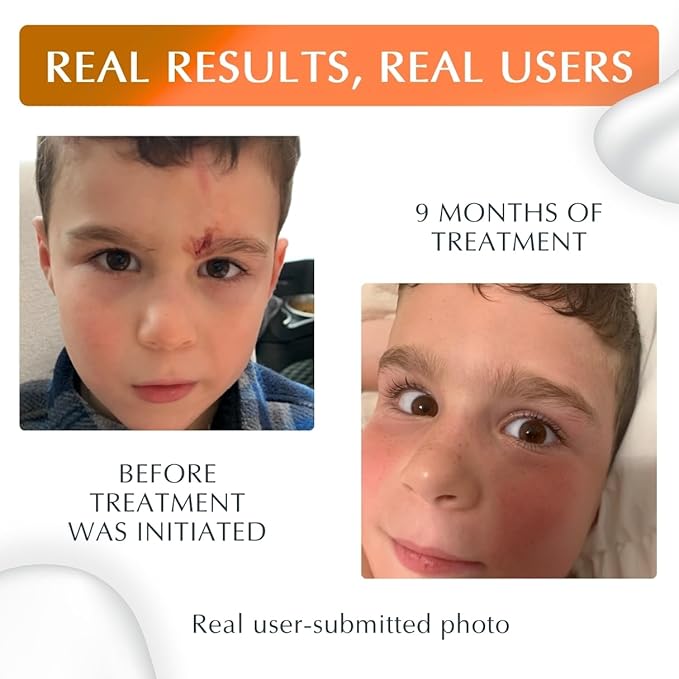 MyNewGel Plus UV Advanced Silicone Scar Gel | Old & New Scars | SPF30 Mineral non-chemical Sunscreen | Ideal for Protecting Scars | Harmful Ultraviolet Rays, 15g (0.5 oz)