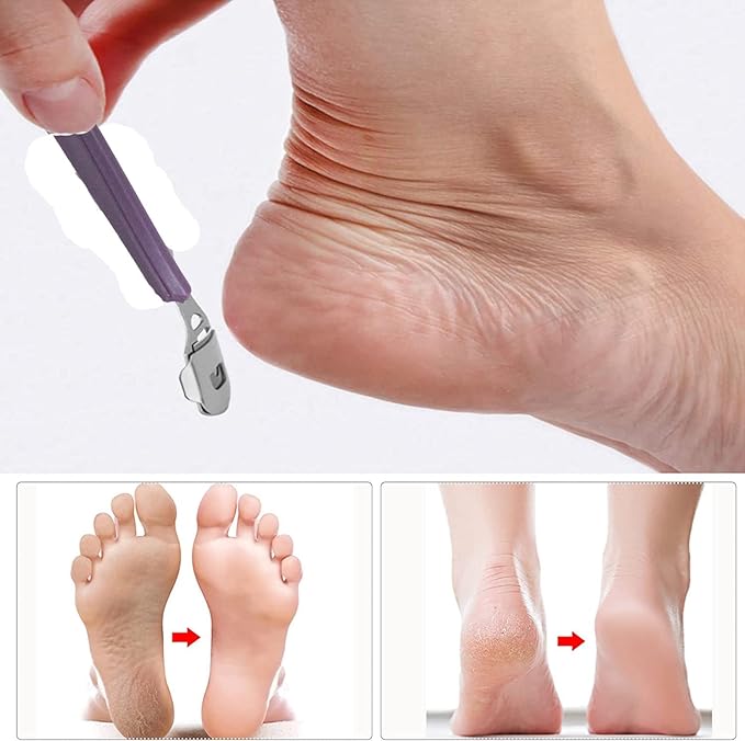 YNR Stainless Steel Calus, Remover for Feet, Foot Scraper & Callus Shaver, Calloused Feet Remover Tool with Callus Shaver Blades, Foot File for Calisis Removal