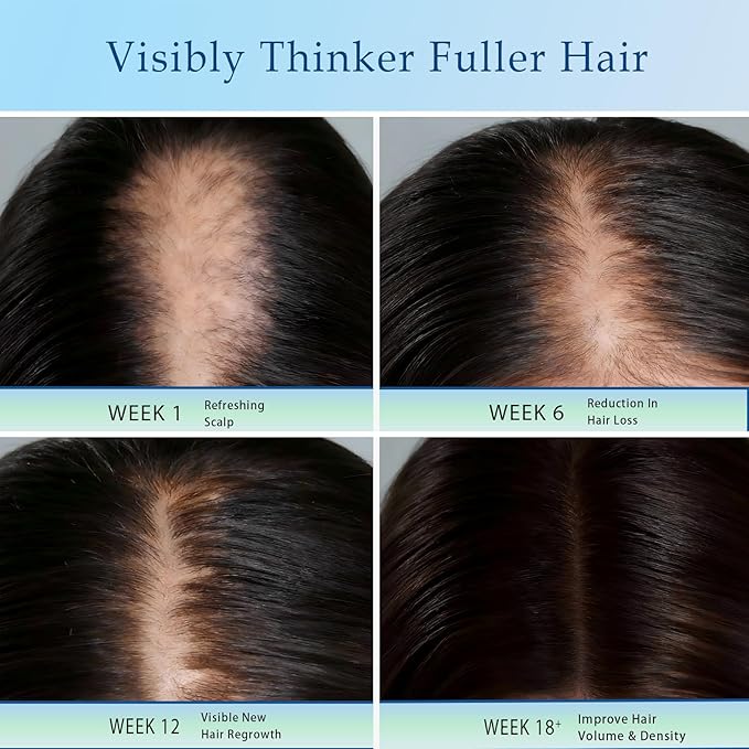 Rosemary Hair Growth Serum Roll On with 3% Rosemary，2% Ginger oil，3% Aloe Vera Extract， Stronger Root，stimulate follicle,Hair Thicker，Hair Loss Treatment.Advanced Hair Regrowth,0.85 Fl Oz pcs