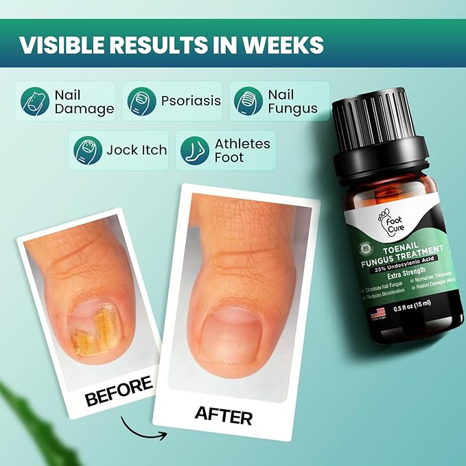 Foot Cure Toenail Fungus Treatment Extra Strength – Athletes Foot Treatment for Toenails, Restorative Nail Repair for Damaged Nails, Toenail Softener with Tea Tree Oil & Oregano Oil - Made in USA