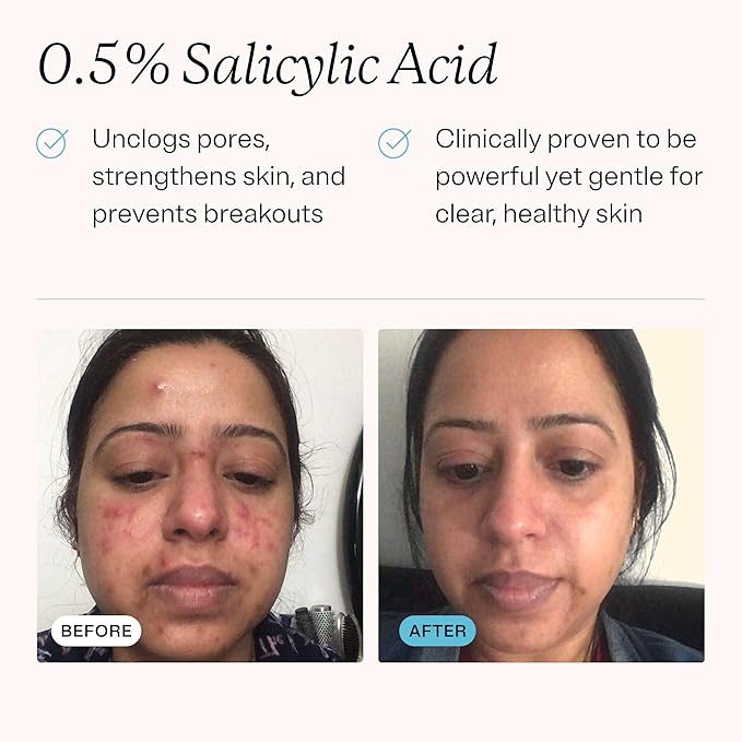 MDacne Hydrating Facial Cleanser 3-Pack with Salicylic Acid 0.5% - Acne Treatment with Plant-Based Ingredients to Remove Dirt & Oil, Protect Skin & Unclog Pores - Calms Redness & Irritation