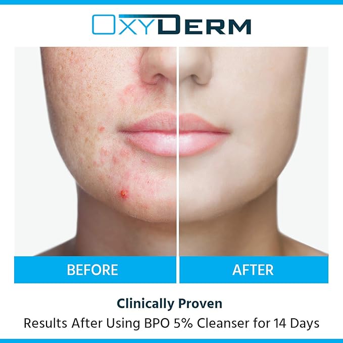 Acne Face wash Treatment with Benzoyl Peroxide 5% - Clinically Proven Wash to Fight Acne Blemishes on Contact. Eliminates Cystic Breakouts, Oily Skin, Clogged Pores, Blackhead, Whitehead, & Pimples.