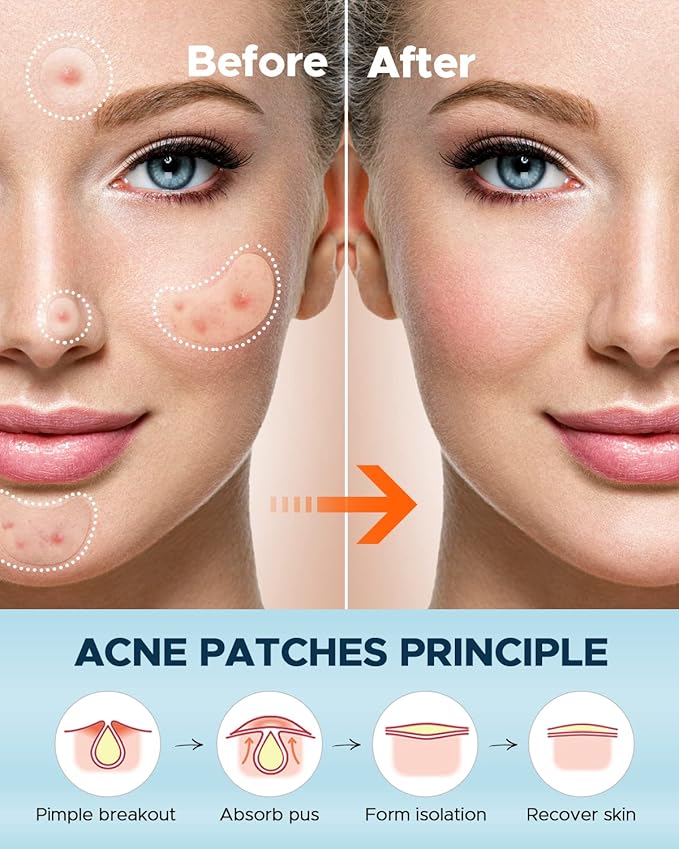 LitBear Large Acne Pimple Patches, 6 Sizes 100 Patches for Large Breakouts, Acne Patches for Face, Chin or Body, Acne Spot Patch with Tea Tree & Calendula Oil, Hydrocolloid Bandages for Acne Skin