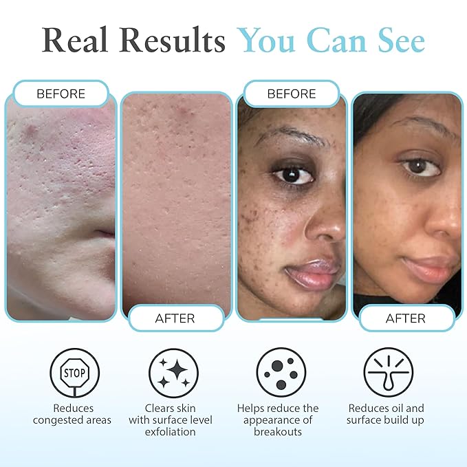 Salicylic 10% Gel Peel, Breakout and Pore Minimizer and Cleanser, 15-30 Full Facial Chemical Peels, 1 fl oz. e, 30 mL – Perfect Image