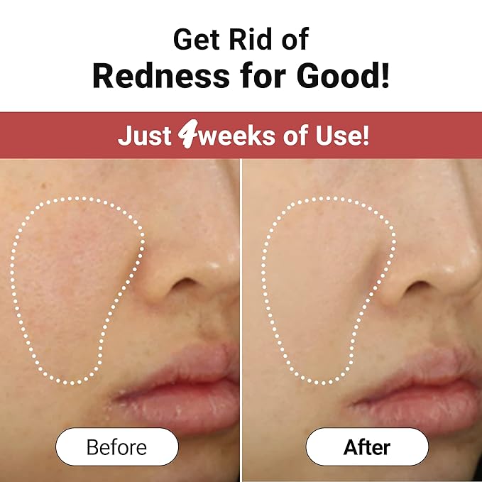 Troubless Clear Redmark Soothing Sheets 5pcs. | Hydrating Face Mask Sheets Beauty Moisturizer | Korean Skin Care for Teen Girls| Beauty Products for Women and Men