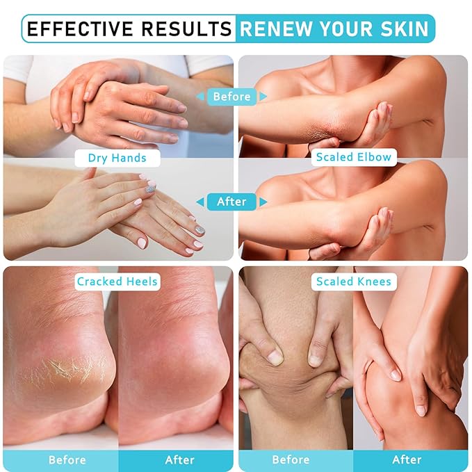 Urea Cream 40 Percent For Feet Maximum Strength - plus Salicylic Acid 2% Foot Cream For Dry Cracked Heels Feet Knees - Dead Skin Cuticle Callus Remover Toenail Softener - Lightly Camellia Scent