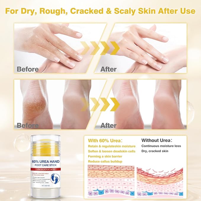 60% Urea Cream with 2% Salicylic Acid Foot Balm, Portable Hand Cream, Foot Cream for Dry Cracked Heels and Feet Hand, Urea Heel Care Stick Callus Remover & Skin Softener, 1oz*2