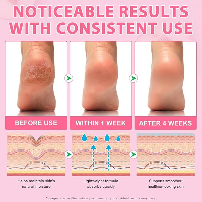 Urea Cream 60% Plus Salicylic Acid 2% Intensive Foot Repair Balm Stick for Dry Cracked/Chapped Heel/Hands Intensively Moisturization, Callus Removal/Softening/Soothing-Peach Scent|1.41 Oz/40 G