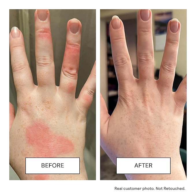 Untoxicated Moisturizing Cream - Facial Moisturizer & Body Cream for Sensitive Skin and NEA Approved for Eczema Relief - Ceramides & Hyaluronic Acid with No Common Irritants